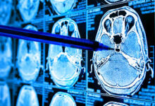 کاربرد هوش مصنوعی در تشخیص سرطان مغز