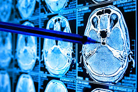 کاربرد هوش مصنوعی در تشخیص سرطان مغز